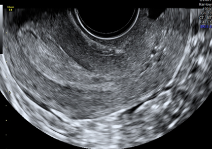 transvaginal scan uterus